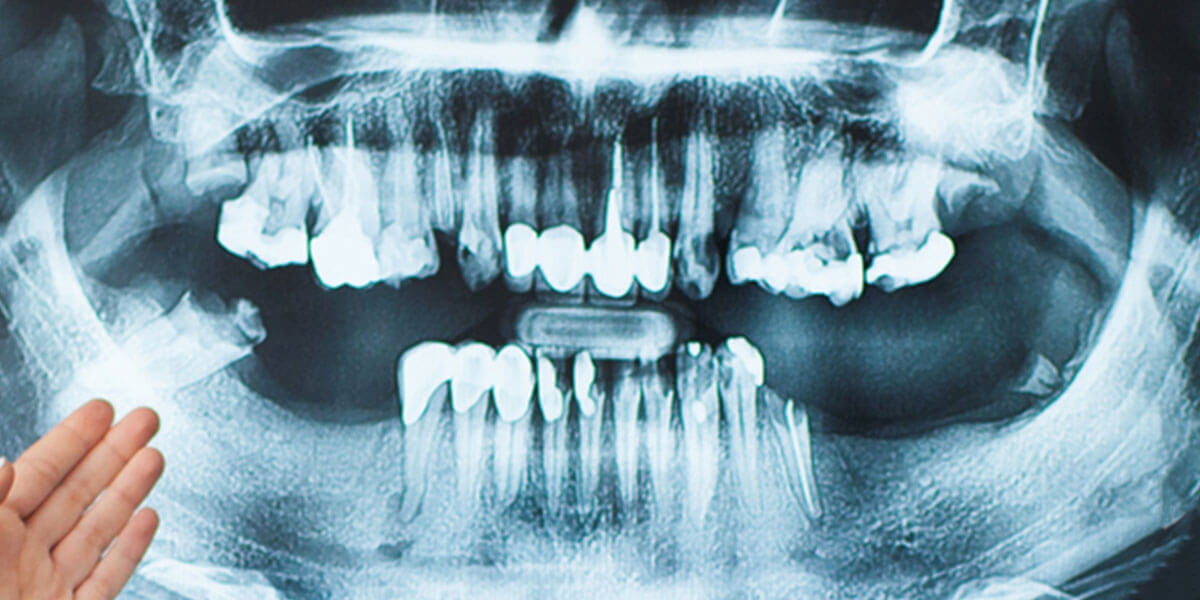 X-ray showing bone loss