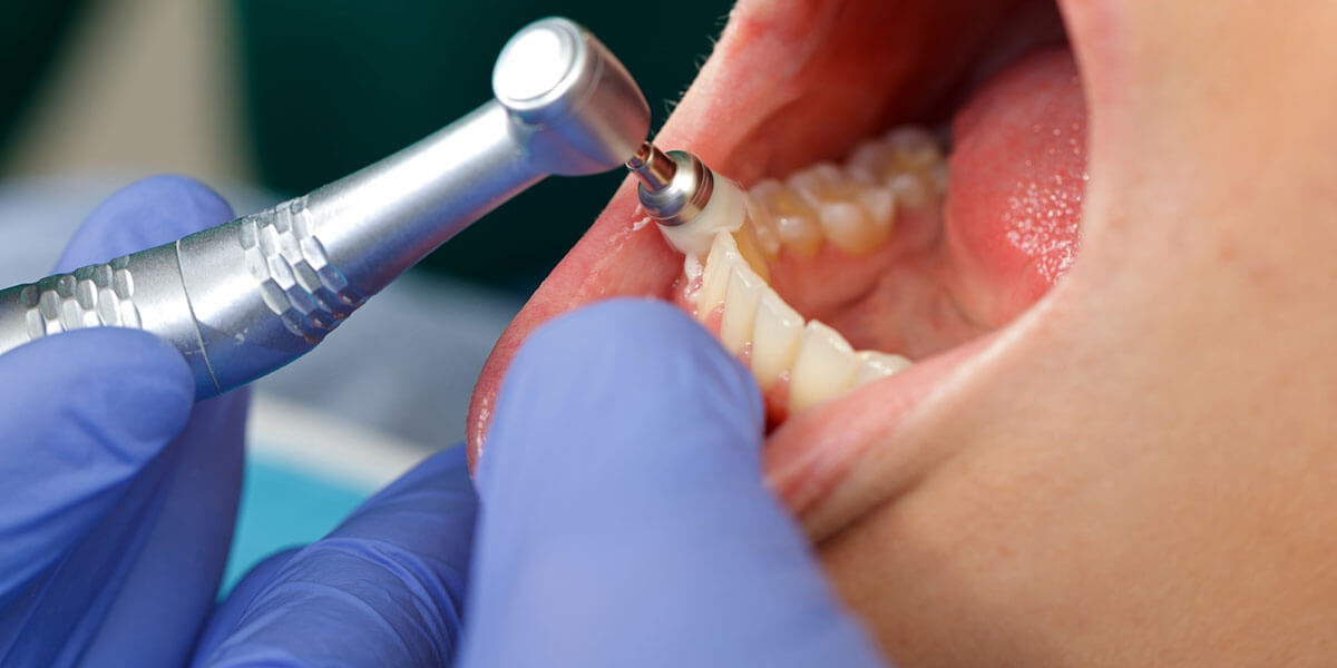 Hand tool removing dental plaque from teeth