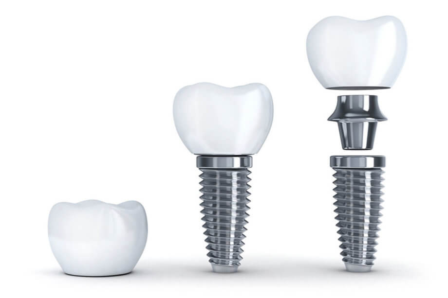 A Step by Step Guide to Dental Implants