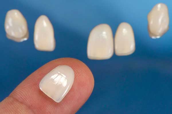 Porcelain Veneers in Manhattan