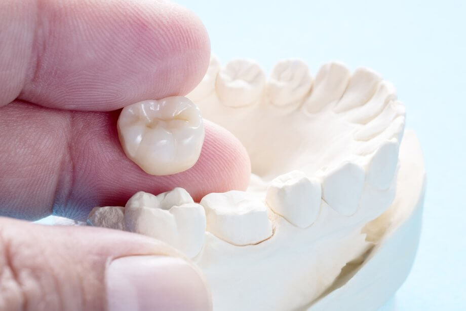 How Long Does it Take to Get a Dental Crown