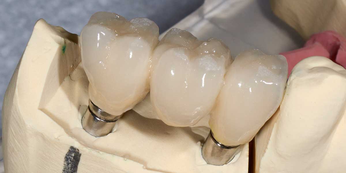 Dental Implant Supported Bridge in NYC