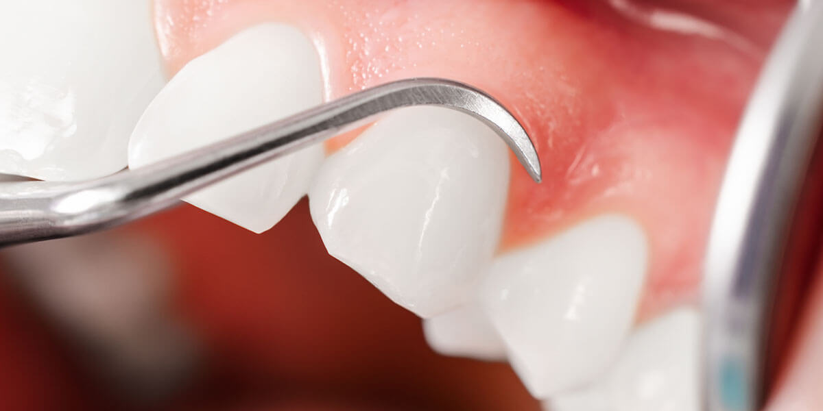 Dental Tool Near Gum line of patients mouth