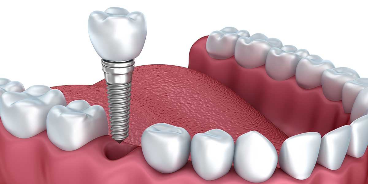 Single Dental Implants in NYC