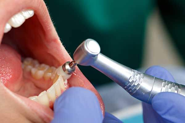 Dental Instrument Removing Plaque from Patient's Tooth