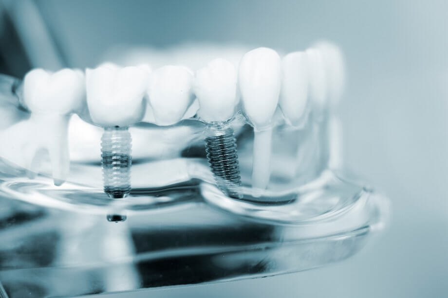 What are Dental Implants