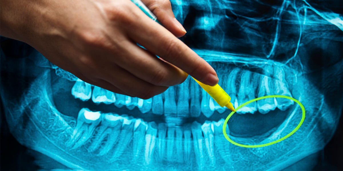 Importance of Dental Implants in Midtown