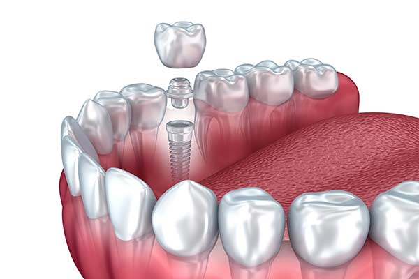 Dental Implant Model