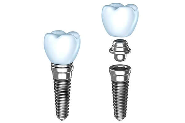 Single Dental Implants in NYC