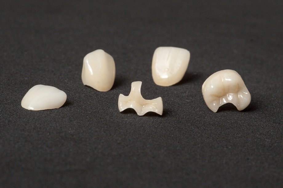 Dental Inlays vs. Onlays: What’s the Difference?