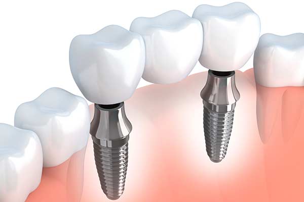 Implant Supported Bridges in NYC