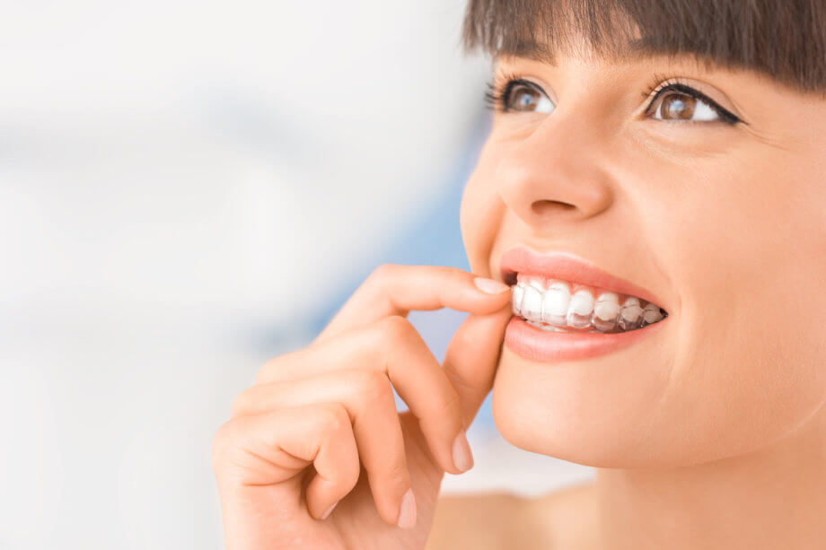 Benefits of Invisalign Over Traditional Braces