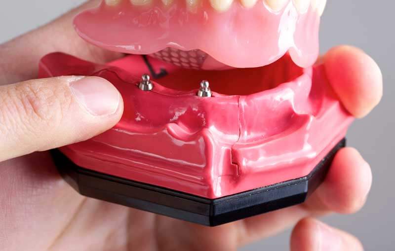 Mini Dental Implants in NYC