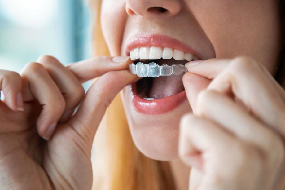 woman placing clear aligners on her teeth