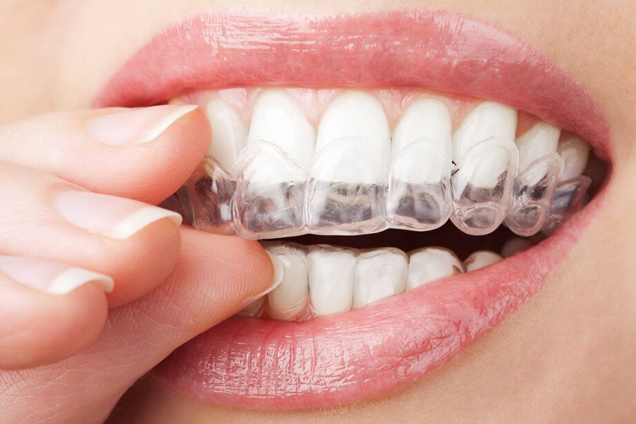 close up of woman's mouth, placing clear aligner on her teeth