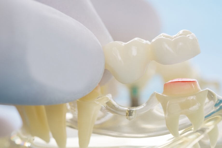 close up of dental bridge model