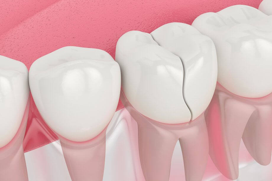 What Do I Do If My Tooth Is Cracked Underneath My Crown?