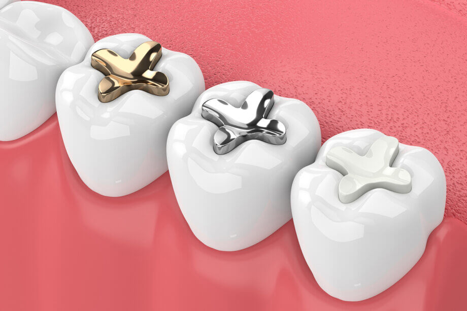 What to Know About Replacing Old Metal Fillings