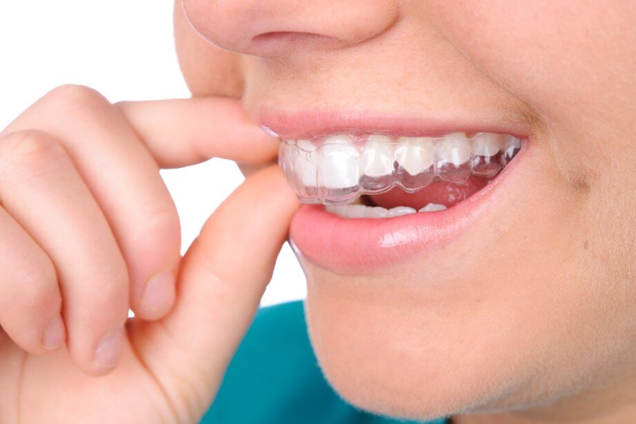 What to Know About Wearing Invisalign on a Night Out in Midtown